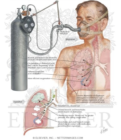 Intermittent Positive Pressure Breathing