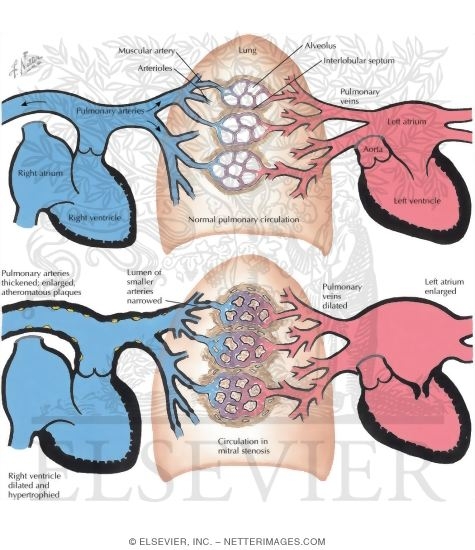 mitral stenosis