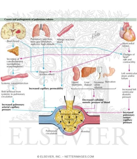 Pulmonary edema pathophysiology
