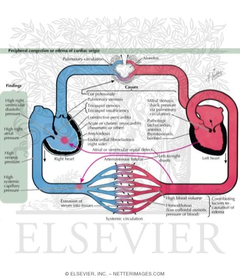 Peripheral Congestion or Edema of Cardiac Origin