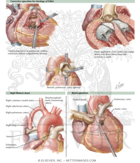 Anomalies of the Right Ventricular - Outflow Tract
Corrective Operation for Tetralogy of Fallot