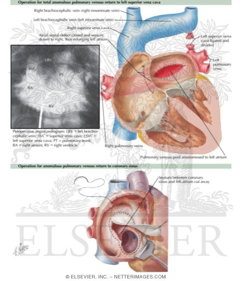 Watermarked preview of labeled image: Anomalous Pulmonary Venous Connection