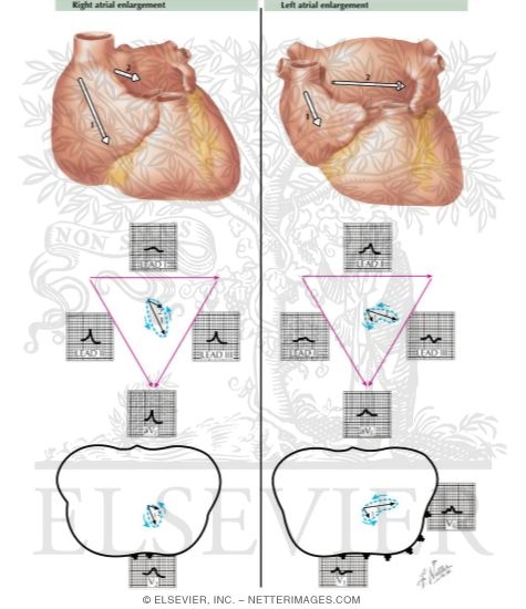 Watermarked preview of labeled image: Atrial Enlargement