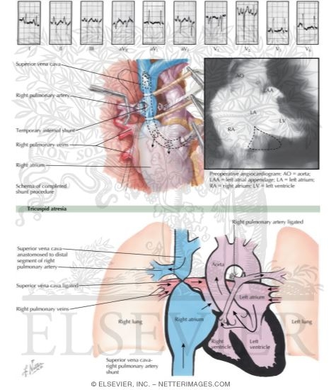 Watermarked preview of labeled image: Anomalies of the Tricuspid Valve