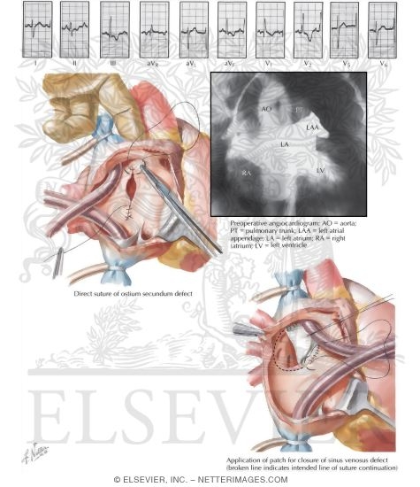 Watermarked preview of labeled image: Defects of the Atrial Septum