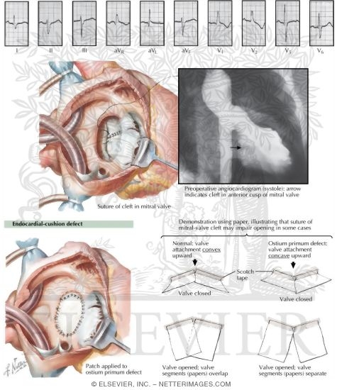 Endocardial - Cushion Defects