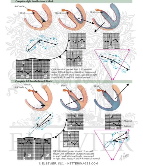 Watermarked preview of labeled image: Bundle Branch Block