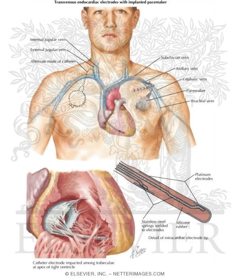 Pacemaker Implantation In Treatment of Complete Heart Block