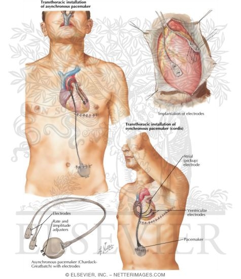 Pacemaker Implantation In Treatment of Complete Heart Block