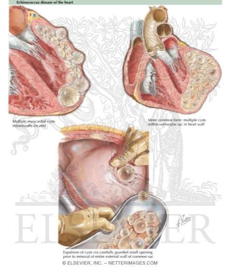 Watermarked preview of labeled image: Echinococcus Cyst (Hydatid Disease)
