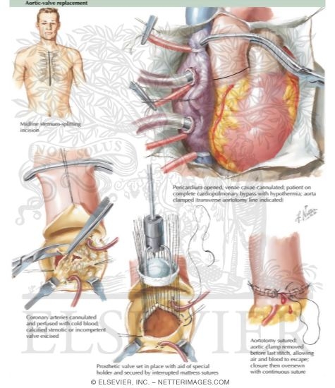 Watermarked preview of labeled image: Aortic Valve Replacement