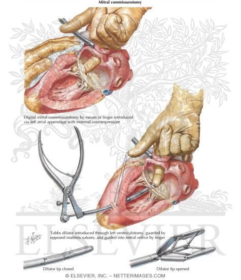 Closed Mitral Commissurotomy