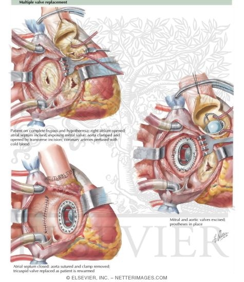 Watermarked preview of labeled image: Multiple Valve Replacement 