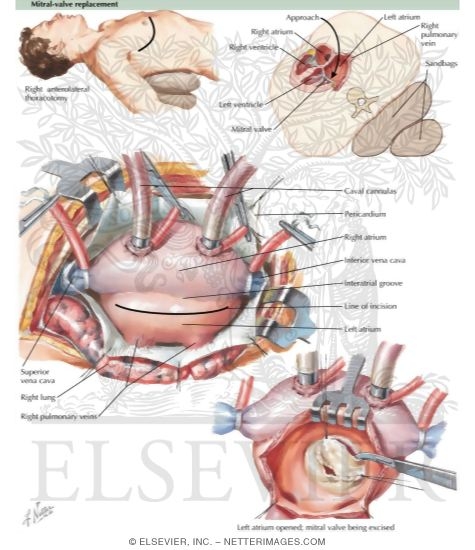 Mitral-Valve Replacement