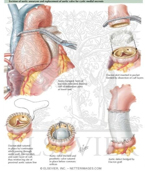 Operation for Cystic Medial Necrosis