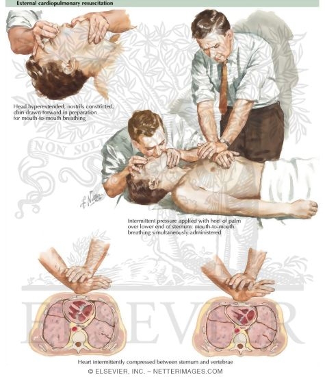 Watermarked preview of labeled image: Cardiopulmonary Arrest and Treatment - External Resuscitation