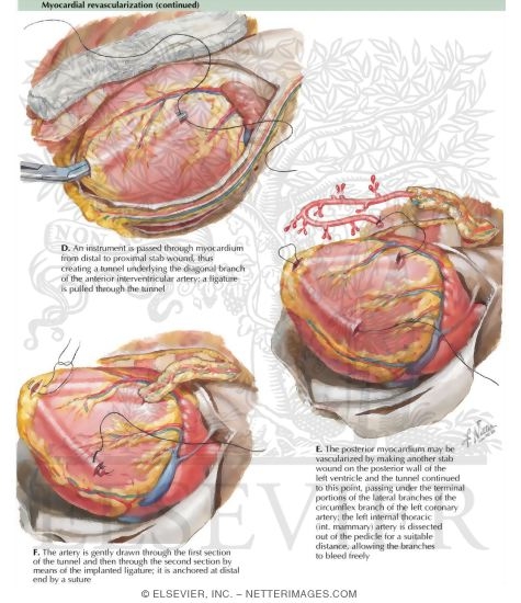 Myocardial Revascularization by the Vineberg-Sewell Implant