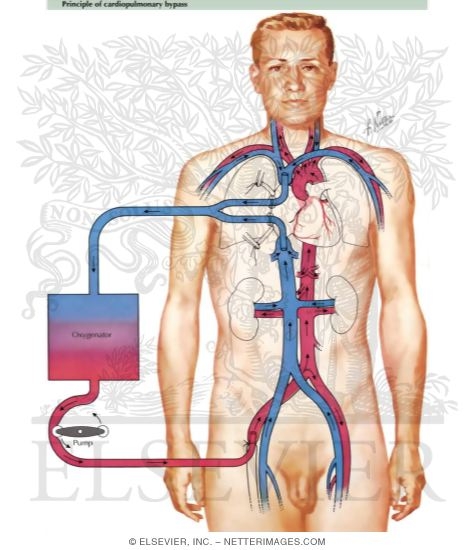 Extracorporeal Circulation - Principle of Cardiopulmonary Bypass
