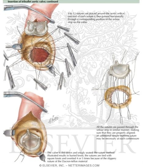 Insertion of Trileaflet Aortic Valve