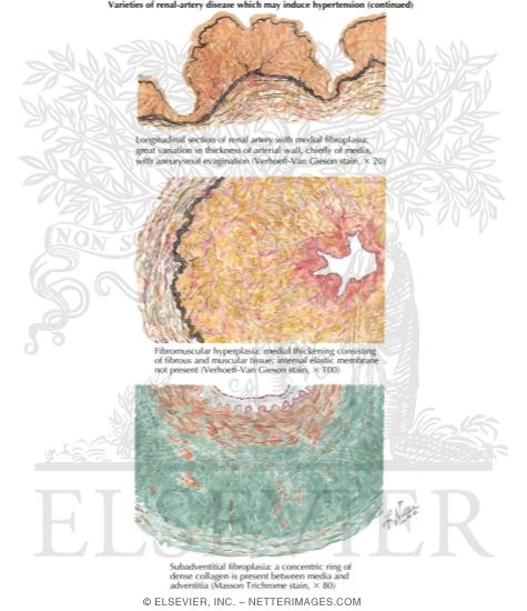 Watermarked preview of labeled image: Occlusive Disease of Main Renal Artery