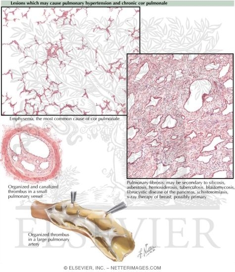 Chronic Cor Pulmonale