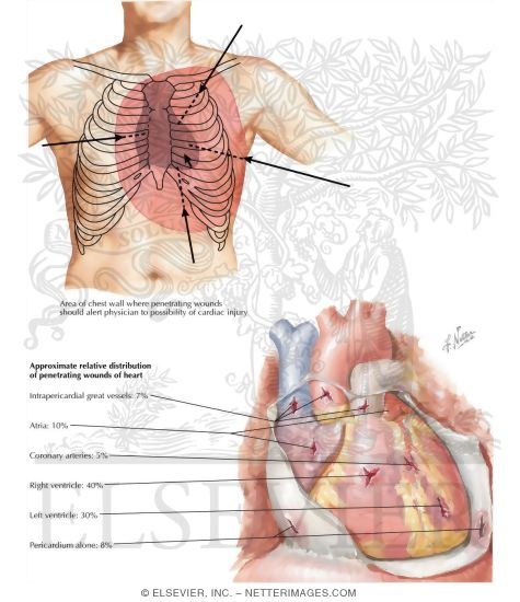 Watermarked preview of labeled image: Penetrating Heart Wounds