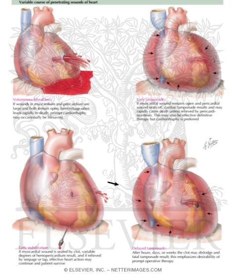 Watermarked preview of labeled image: Penetrating Heart Wounds