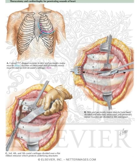 Watermarked preview of labeled image: Penetrating Heart Wounds