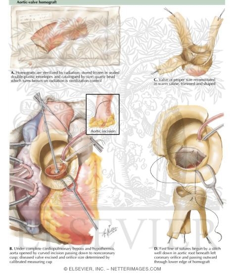 Watermarked preview of labeled image: Aortic-Valve Homograft
