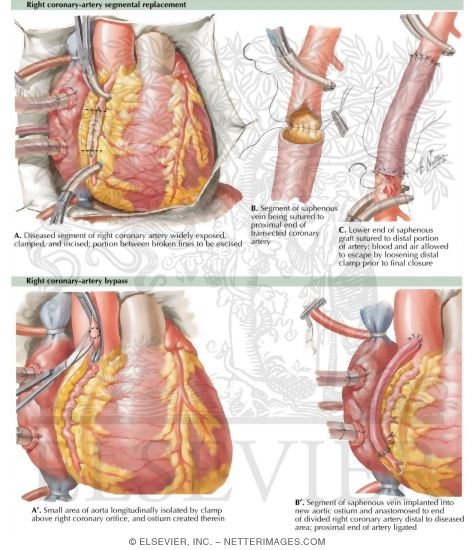 Watermarked preview of labeled image: Segmental Replacement of Right Coronary Artery-Bypass of Right Coronary Artery