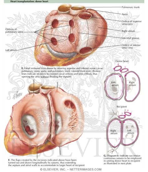 Heart Transplantation - Donor Heart