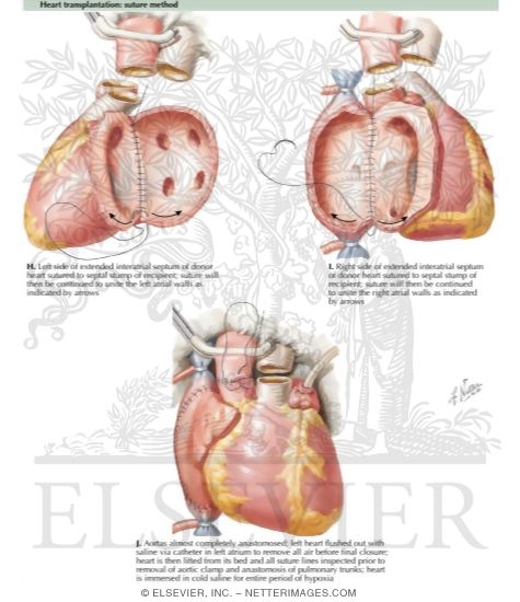 Heart Transplantation - Suture Method