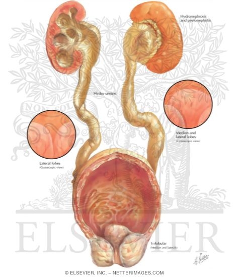 Watermarked preview of labeled image: Benign Prostatic Hypertrophy