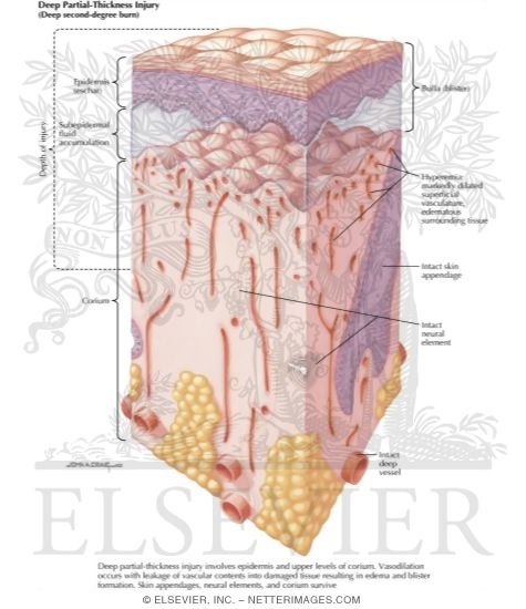 Watermarked preview of labeled image: Deep Partial Thickness Injury of the Skin