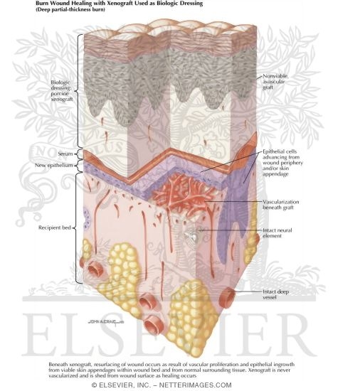 Burn Wound Healing With Xenograft Used As Biologic Dressing