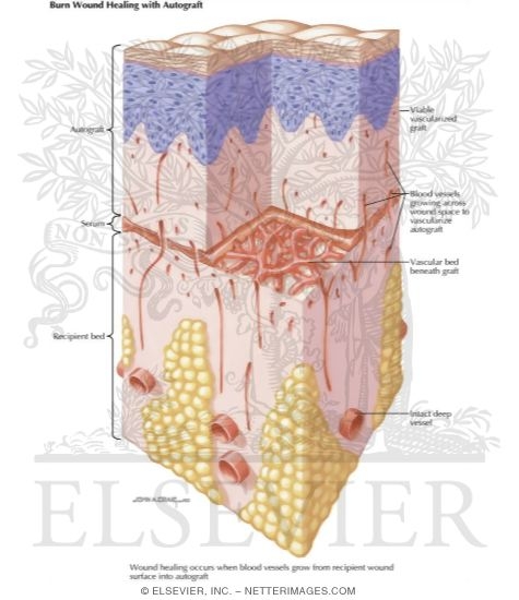 Watermarked preview of labeled image: Burn Wound Healing With Autograft