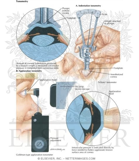 Watermarked preview of labeled image: Tonometry