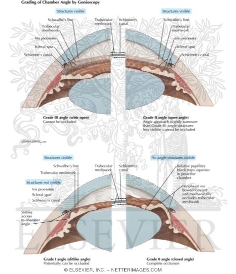 Grading of Chamber Angle By Gonioscopy