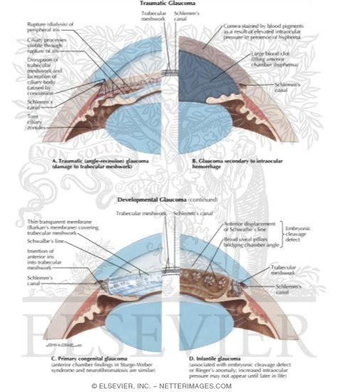 Watermarked preview of labeled image: Traumatic Glaucoma