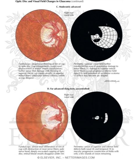 Watermarked preview of labeled image: Optic Disc and Visual Field Changes In Glaucoma