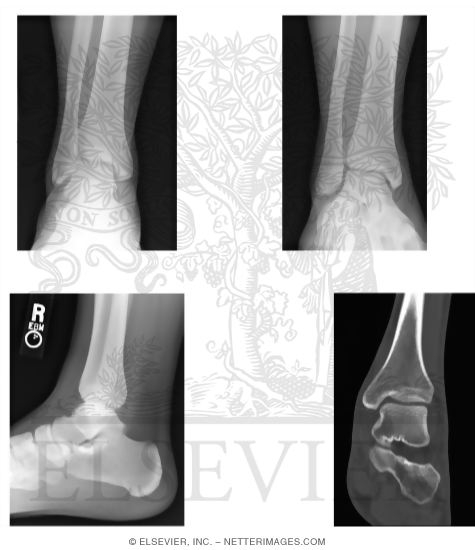 Watermarked preview of unlabeled image: Radiology of the Foot and Ankle