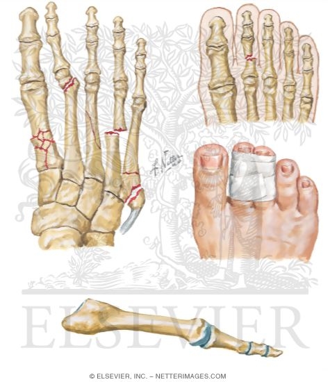 Watermarked preview of unlabeled image: Trauma of the Foot and Ankle
