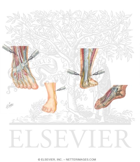 Watermarked preview of unlabeled image: Minor Procedures of the Foot and Ankle