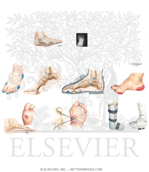 Watermarked preview of unlabeled image: Disorders of the Foot and Ankle