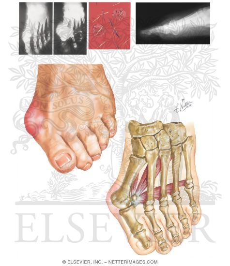 Watermarked preview of unlabeled image: Disorders of the Foot and Ankle