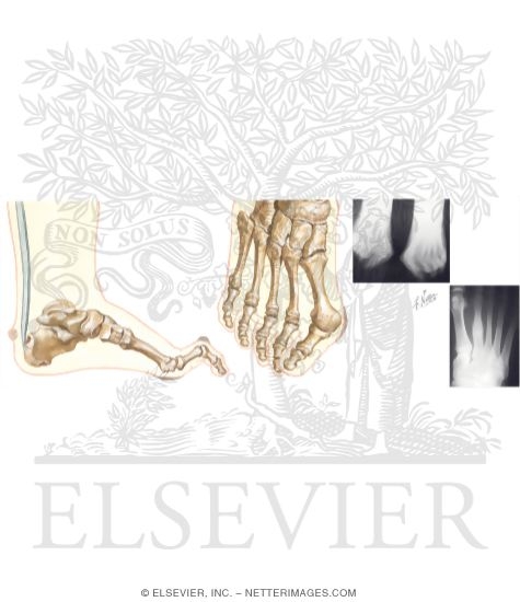 Watermarked preview of unlabeled image: Disorders of the Foot and Ankle