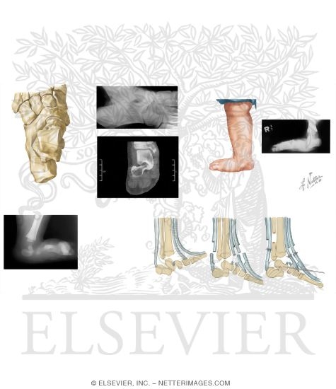 Watermarked preview of unlabeled image: Pediatric Disorders of the Foot and Ankle