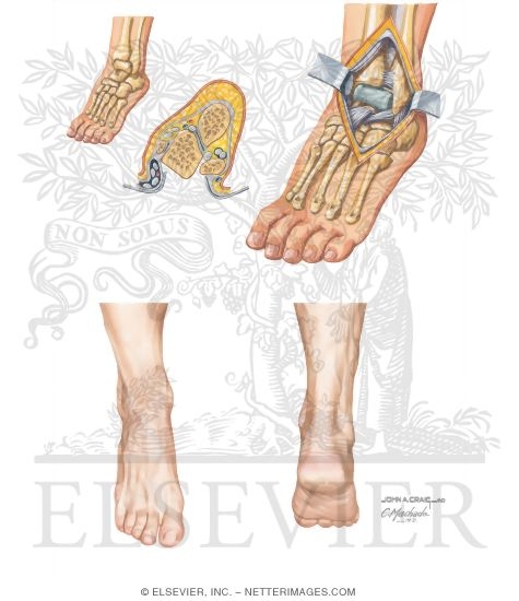 Watermarked preview of unlabeled image: Surgical Approaches to the Foot and Ankle