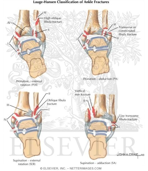 Lauge-Hansen Classification of Ankle Fracture