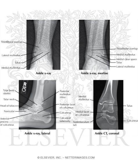 Watermarked preview of labeled image: Radiology of the Foot and Ankle